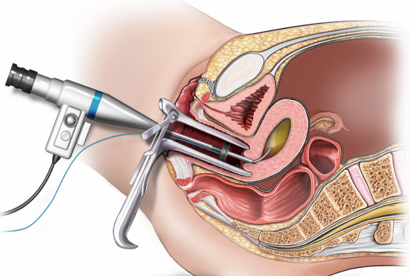 Hysteroscopy
